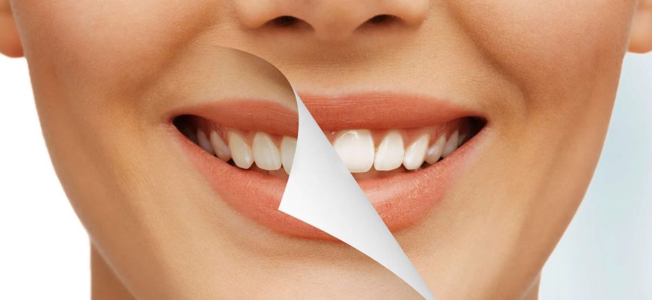 عوارض بلیچینگ دندان