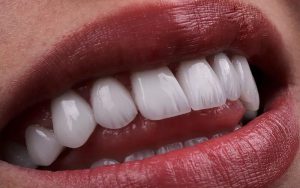 لمینت کریستالی برای چه کسانی مناسب است؟