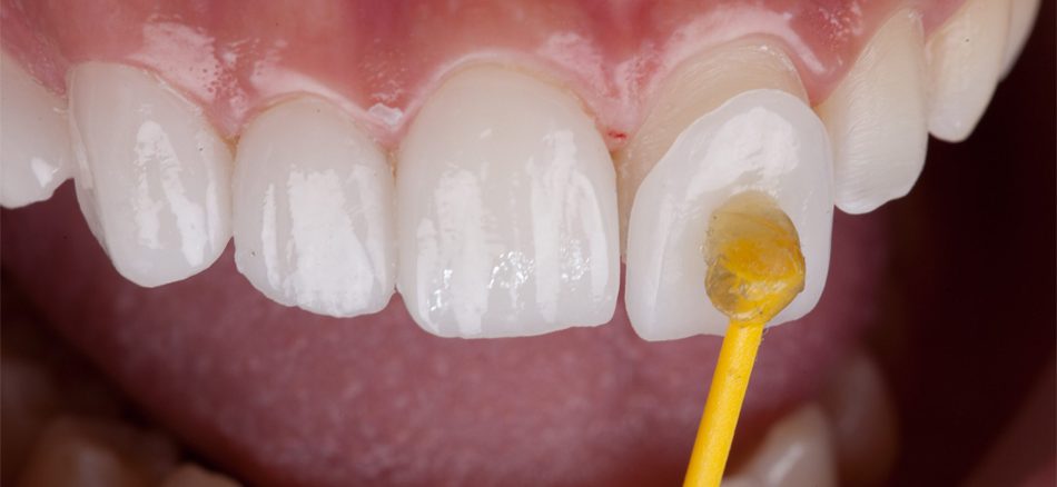 همه چیز درباره لمینت کریستالی