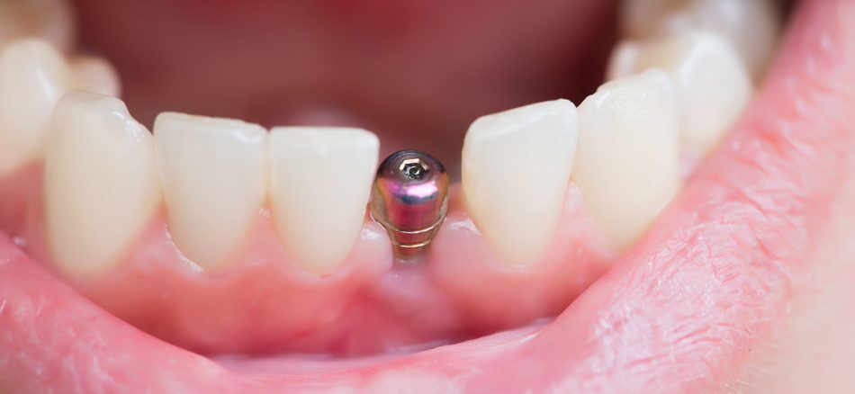 مراحل ایمپلنت دندان