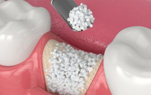dental implant bone transplant