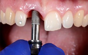 dental implant front tooth