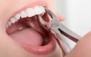 removing tooth