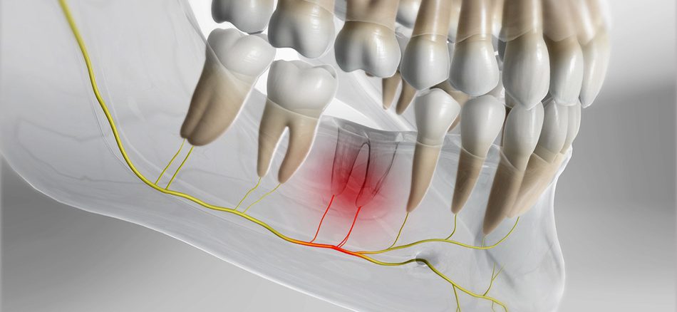 حفره خشک دندان