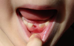 The cause of dry tooth cavity