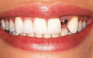 Common complications of dental implants