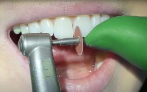 آیا دندانها تراشیده میشوند؟