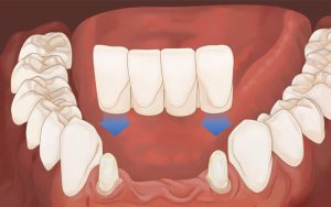 روش جدید کاشت دندان بدون ایمپلنت=